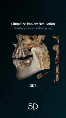 10.Simplified implant simulation(Clipping)