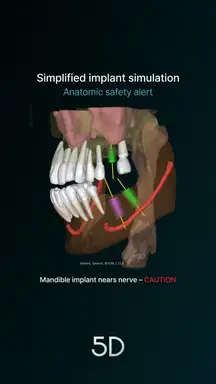 14. Simplified implant simulation - Anatomic safety caution