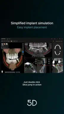 13 Simplified implant simulation -Easy implant placement