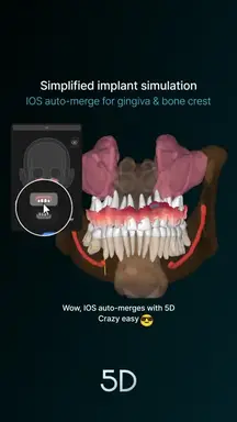 17. IOS auto-merge for gingiva & bone crest