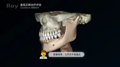 5D_Palatine suture_horizontal_CN